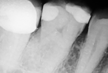  Dentalinė rentgeno nuotrauka (RVG)