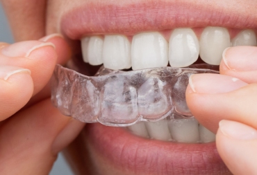 Kaip elgtis pradėjus nešioti dantų tiesinimo kapas?