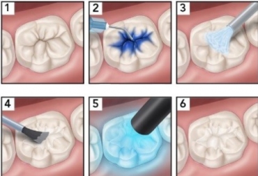 Kas yra dantų silantai ir kam jie reikalingi?
