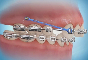 Kas yra ortodontinis implantas ir kam jis reikalingas?