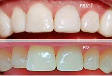 Kodėl po estetinio dantų plombavimo reikalingas dantų poliravimas?