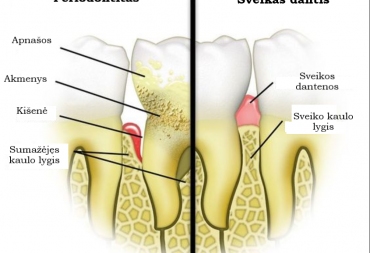 Periodontitas