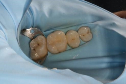 Dantų karieso gydymas - po