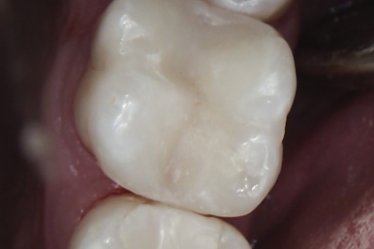 Dantų karieso gydymas - po