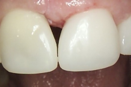 Dantų gydymas - po