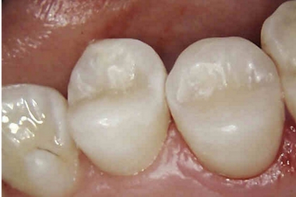 Dantų gydymas - po