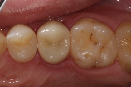 Dantų šaknų kanalų gydymas - po