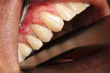 Estetinis dantų plombavimas - po