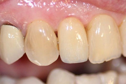 Dantų implantacija - po
