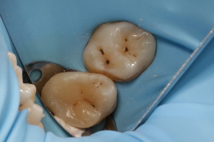 Dantų šaknų kanalų gydymas - po