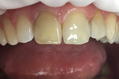 Dantų protezavimas - pries