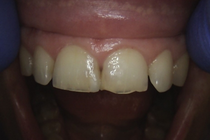 Estetinis dantų plombavimas - pries