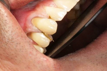 Estetinis dantų plombavimas - pries