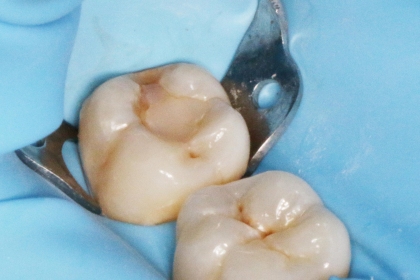 Dantų šaknų kanalų gydymas - pries