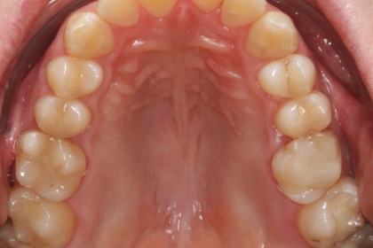 Dantų šaknų kanalų gydymas - pries