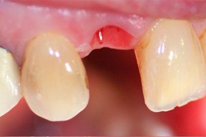 Kelių dantų defektas - pries