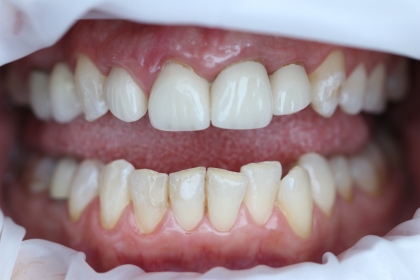Dantų protezavimas - pries