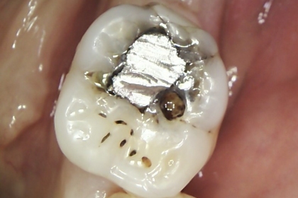 Dantų karieso gydymas - pries