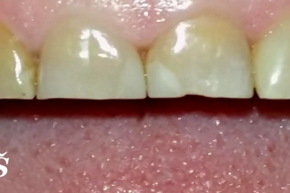 Dantų gydymas - pries