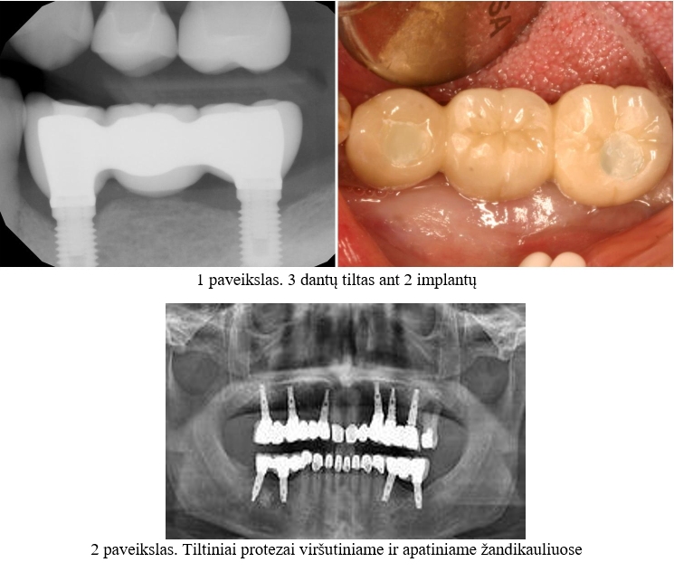 3 dantų tiltas ant 2 implantų