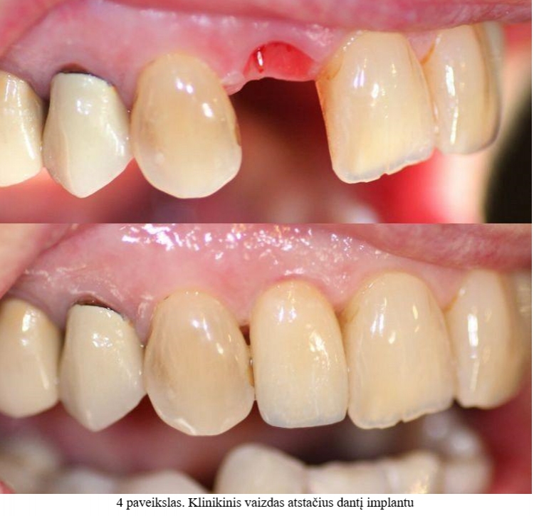 Klinikinis vaizdas atstačius dantį implantu