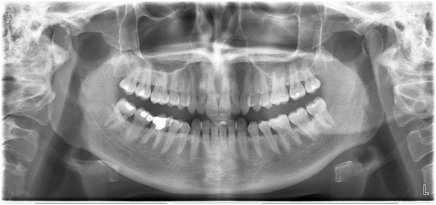 Skaitmeninė panoraminė burnos nuotrauka (ortopantomograma)