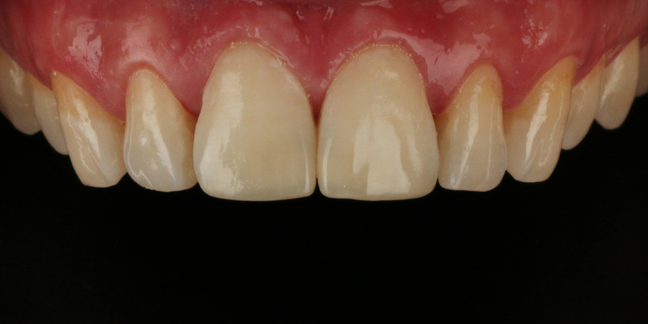 Po estetinio dantų plombavimo