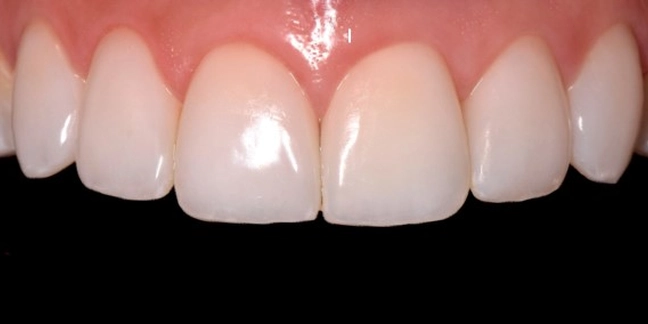 Po estetinio dantų plombavimo