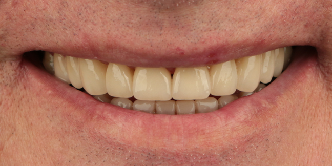 Po dantų protezavimo