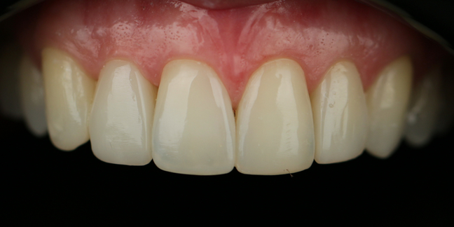 Po estetinio dantų plombavimo