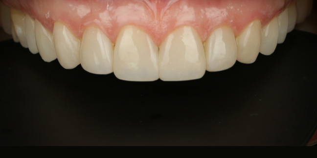 Po estetinio dantų plombavimo