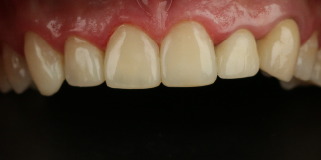 Po estetinio dantų plombavimo