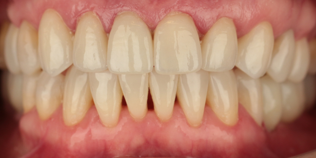 Po dantų protezavimo