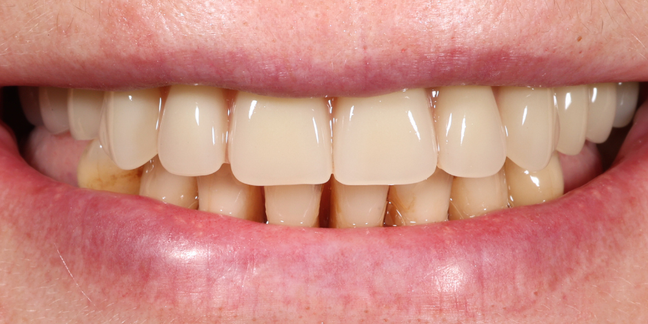 Po dantų protezavimo