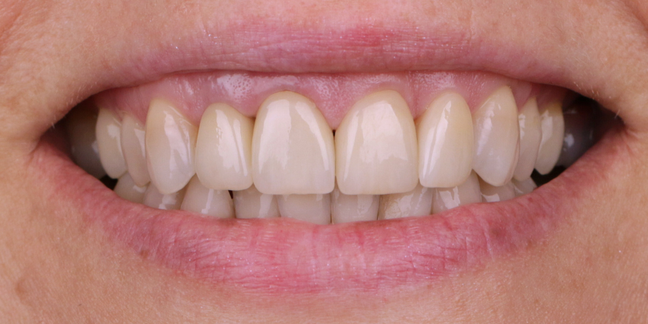 Po dantų protezavimo