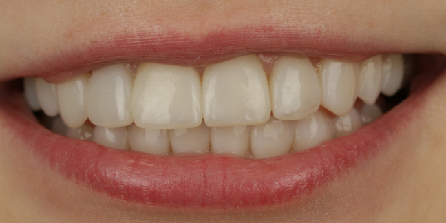 Po estetinio dantų plombavimo