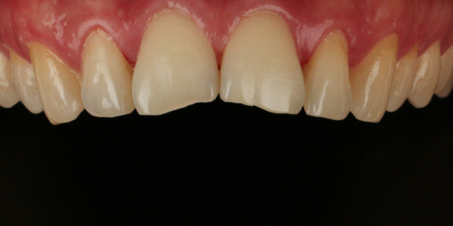 Prieš estetinį dantų plombavimą