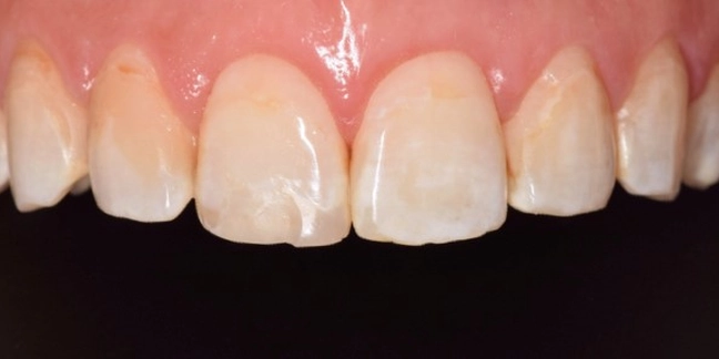 Prieš estetinį dantų plombavimą