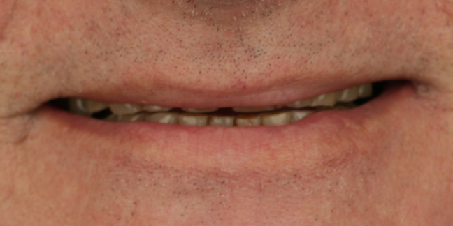 Prieš dantų protezavimą