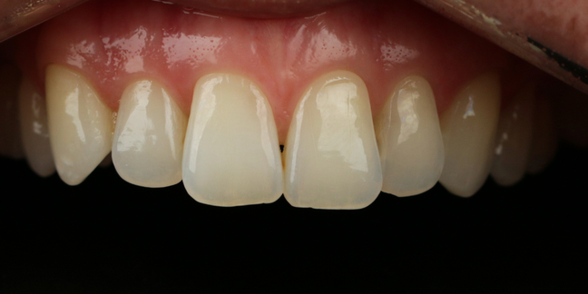 Prieš estetinį dantų plombavimą