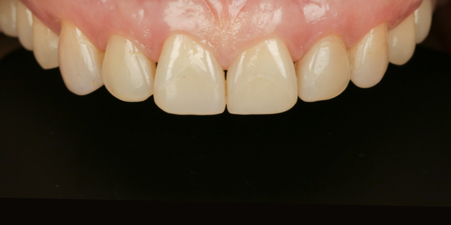 Prieš estetinį dantų plombavimą