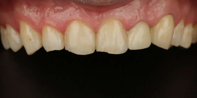 Prieš estetinį dantų plombavimą