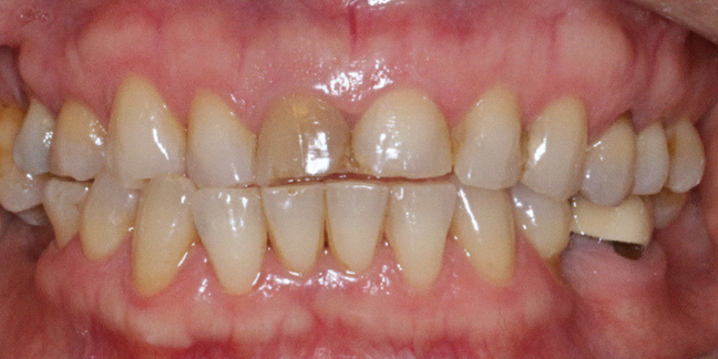 Prieš dantų protezavimą