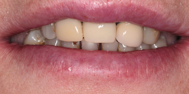 Prieš dantų protezavimą