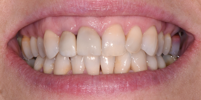 Prieš dantų protezavimą