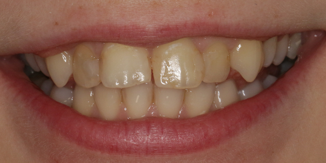 Prieš estetinį dantų plombavimą